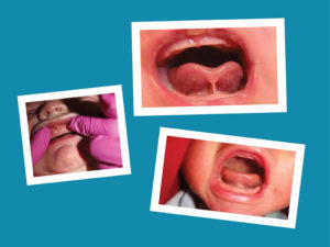 Read more about the article Tethered Oral Tissues (TOTS)